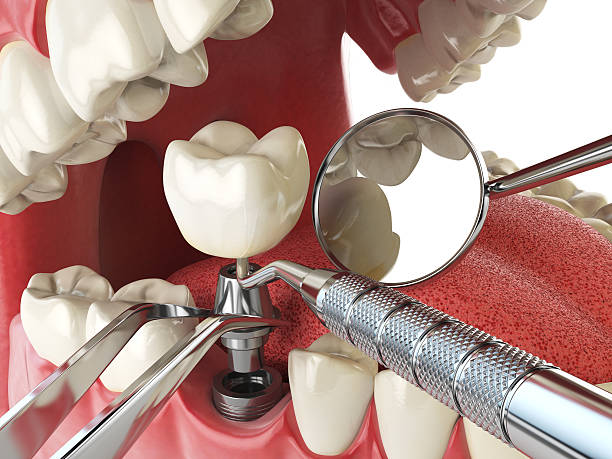 Best Broken or Cracked Tooth Emergency Dentist in Cherry Valley, CA